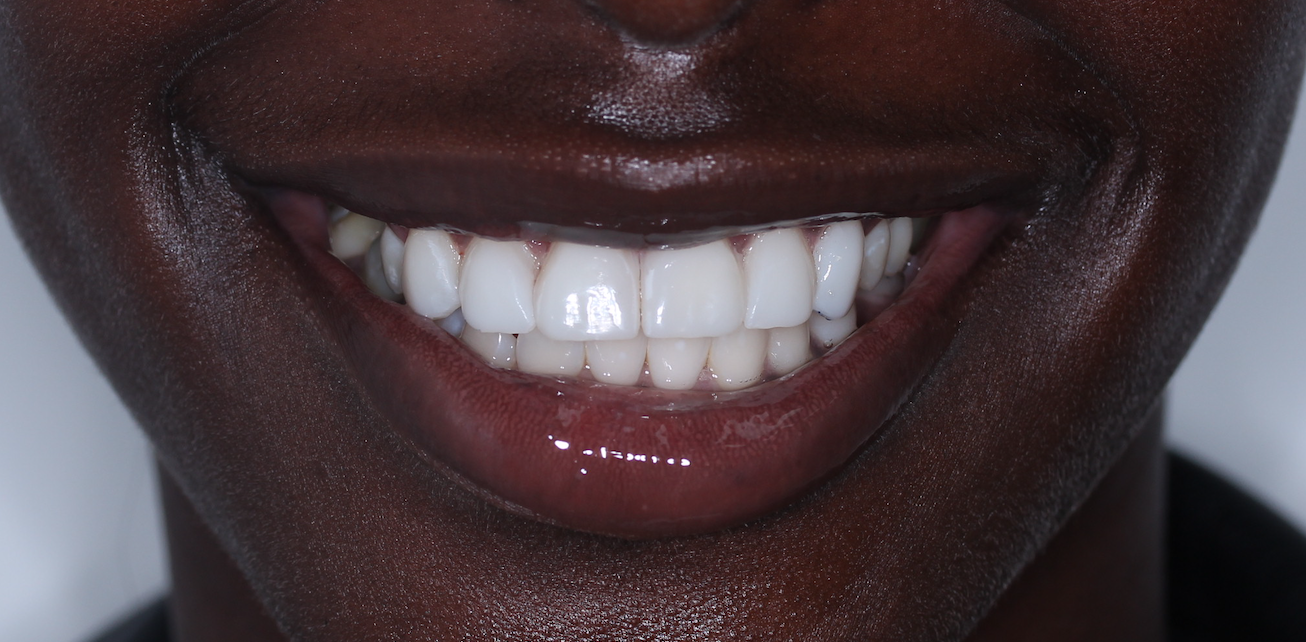 Composite Bonding Wimbledon Wimbledon Dove Dental Spa