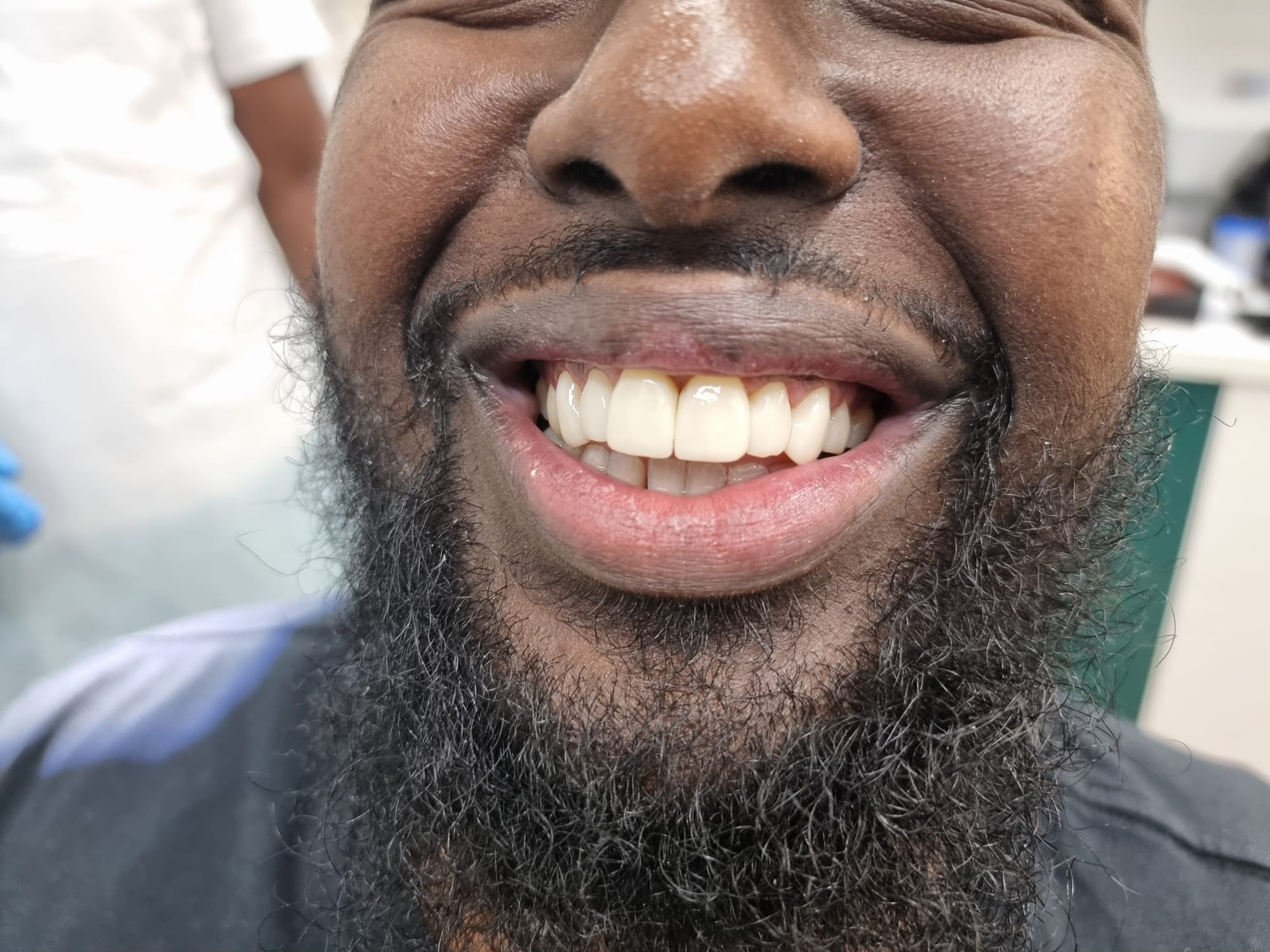 Composite Bonding Wimbledon Wimbledon Dove Dental Spa