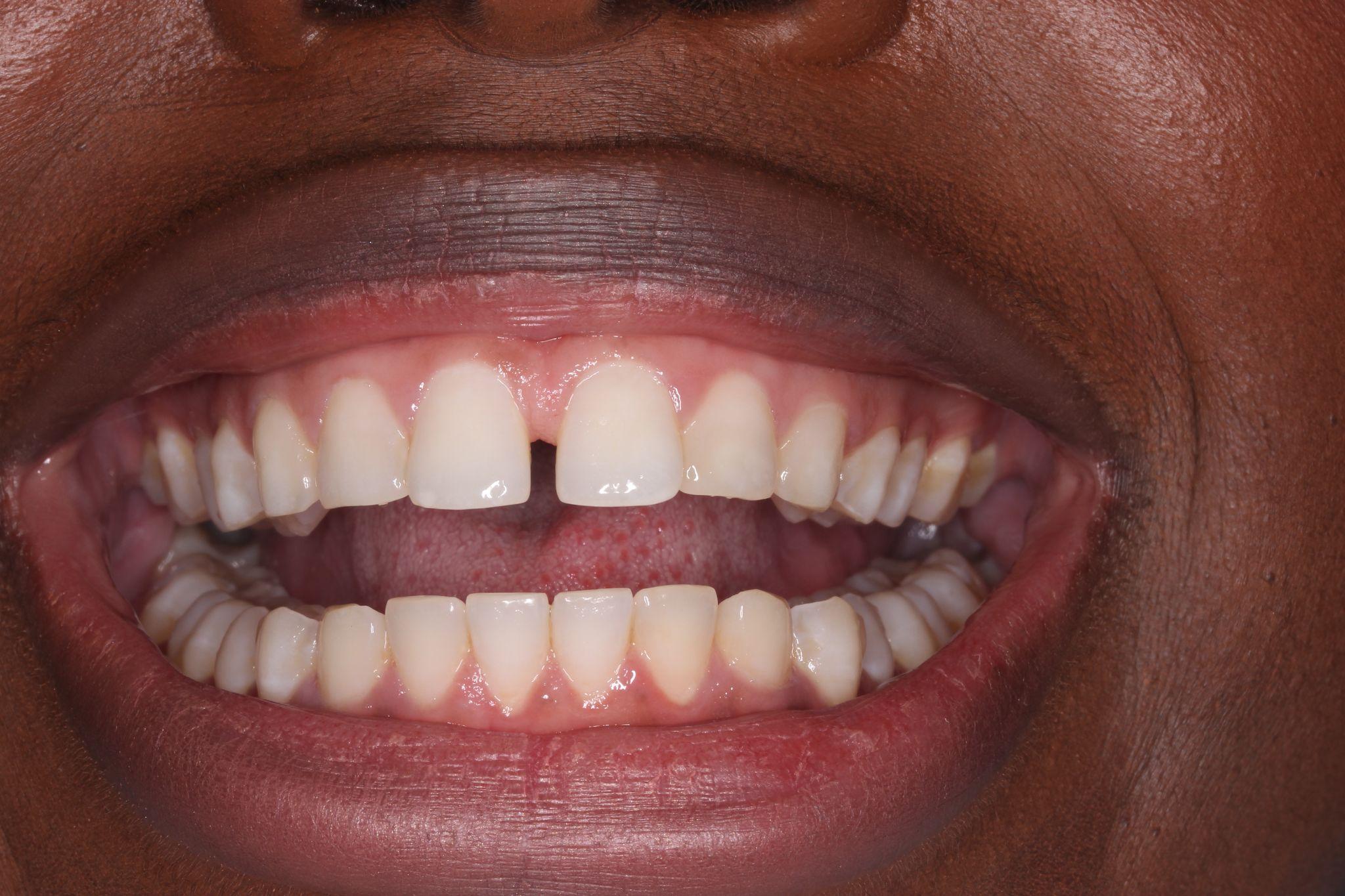 Composite Bonding Wimbledon Wimbledon Dove Dental Spa